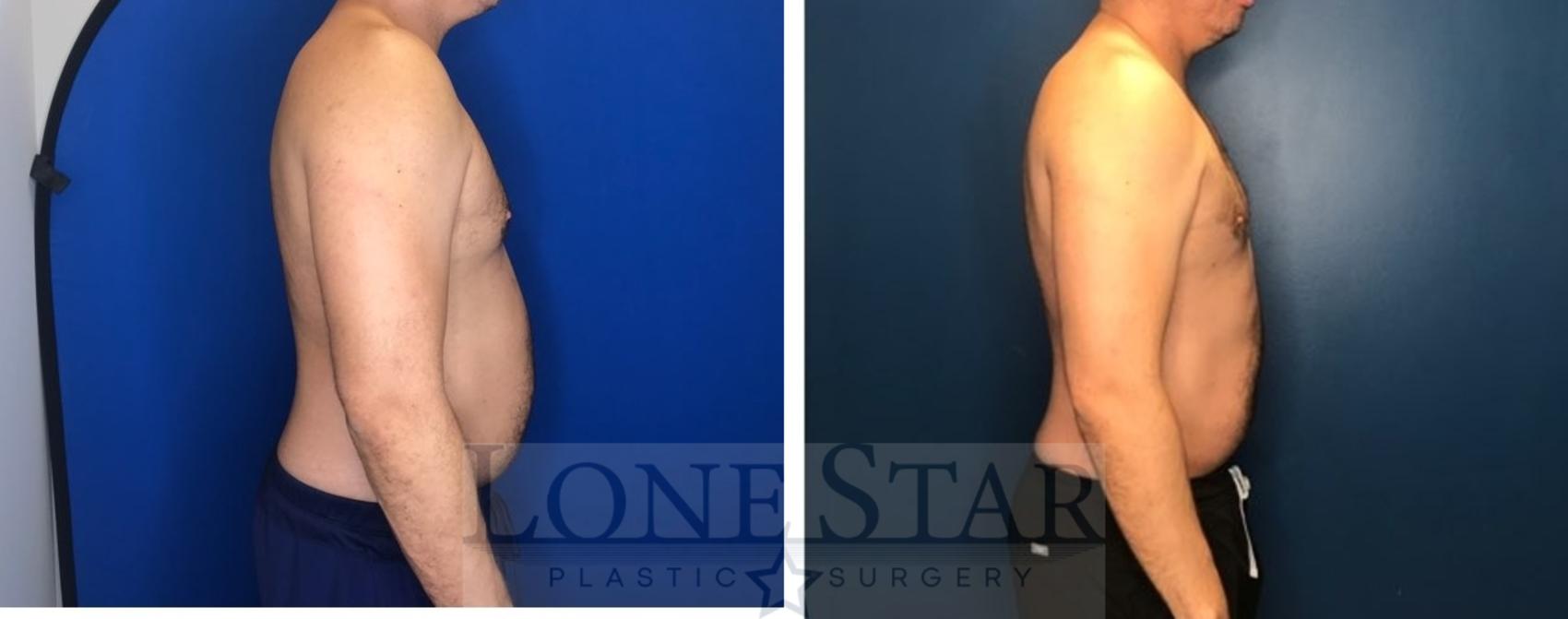 Before & After Liposuction Case 78 Right Side View in Frisco, TX