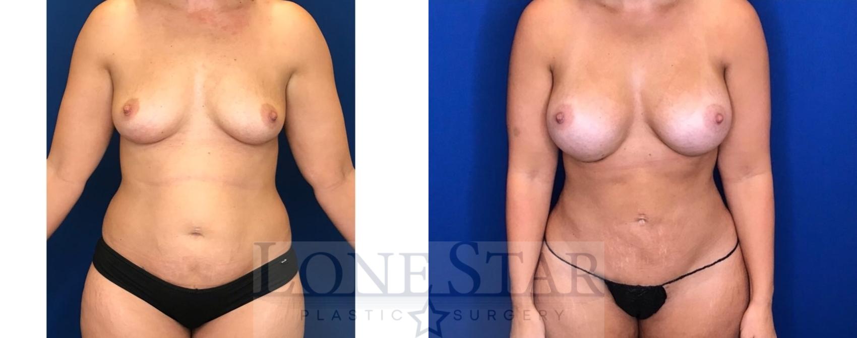 Before & After Liposuction Case 92 Front View in Frisco, TX