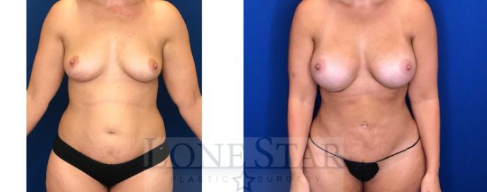 Before & After Breast Augmentation Case 92 Front View in Frisco, TX