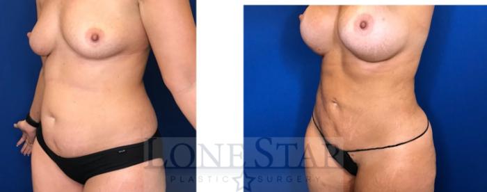 Before & After Liposuction Case 92 Left Oblique View in Frisco, TX