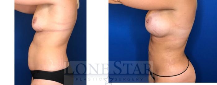 Before & After Breast Augmentation Case 92 Left Side View in Frisco, TX