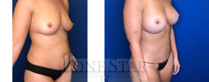 Before & After Breast Augmentation Case 92 Right Oblique View in Frisco, TX