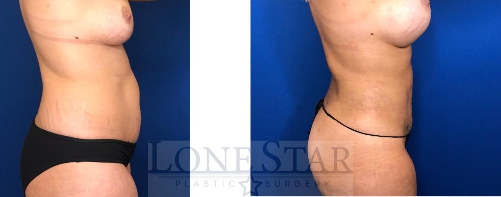Before & After Liposuction Case 92 Right Side View in Frisco, TX