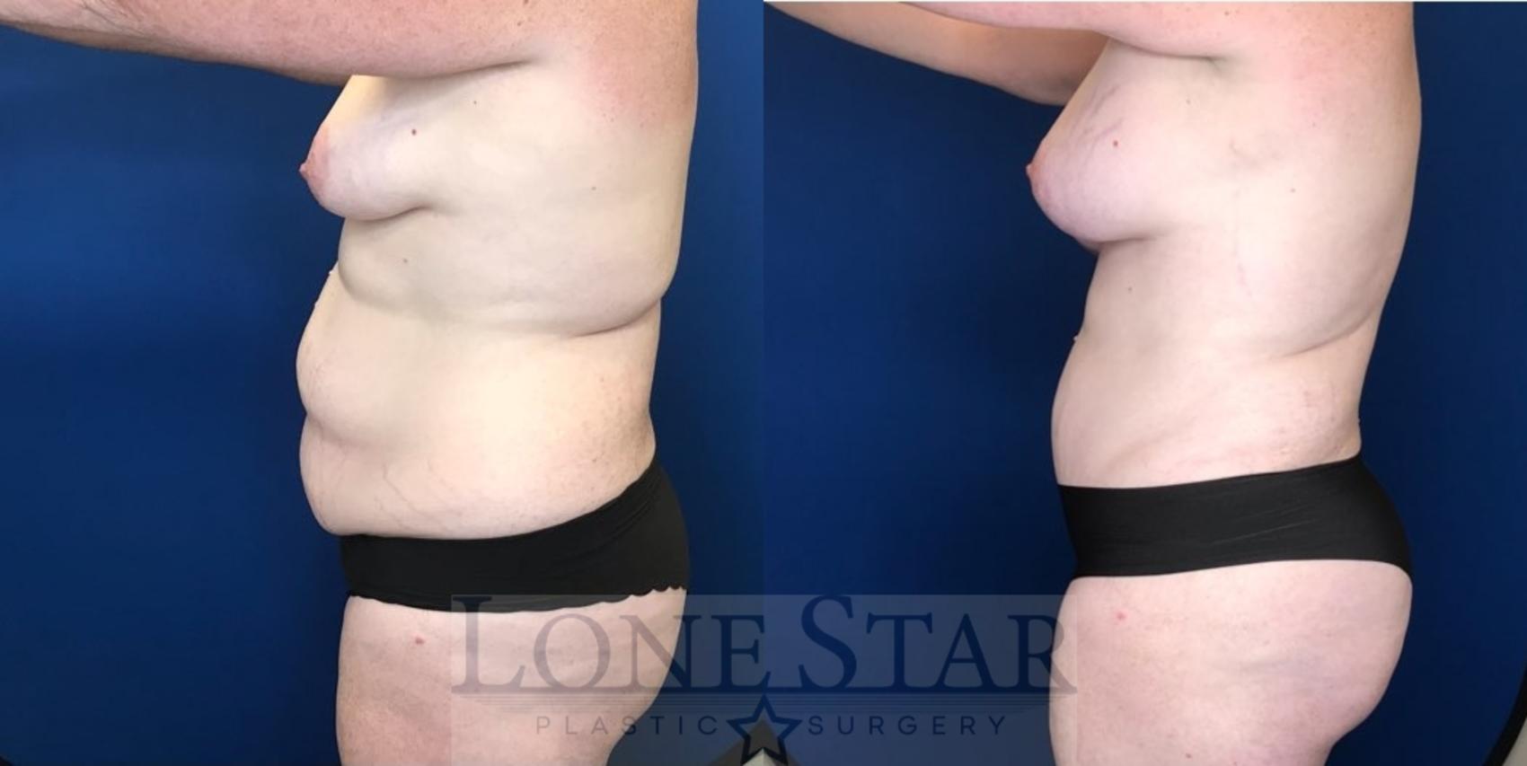Before & After Mommy Makeover Case 102 Left Oblique View in Frisco, TX