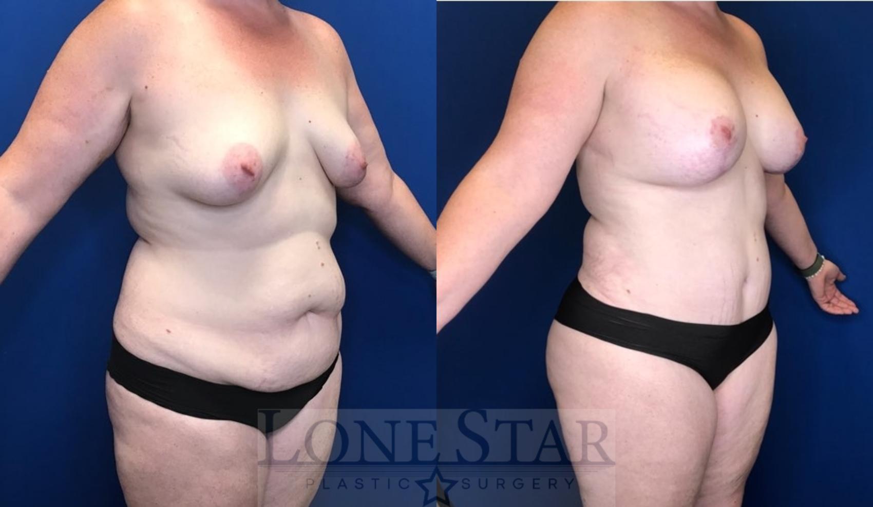 Before & After Mommy Makeover Case 102 Right Oblique View in Frisco, TX