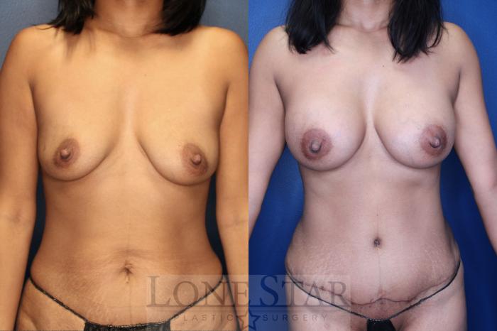 Before & After Breast Augmentation Case 148 Right Side View in Frisco, TX