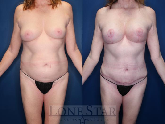 Before & After Breast Lift Case 152 Front View in Frisco, TX