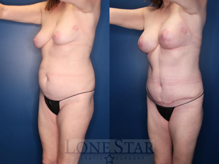 Before & After Breast Lift Case 152 Left Oblique View in Frisco, TX