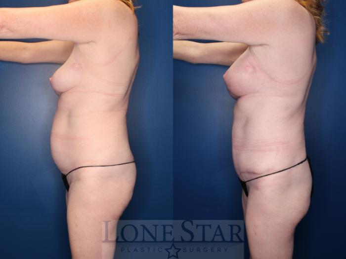 Before & After Breast Lift Case 152 Left Side View in Frisco, TX