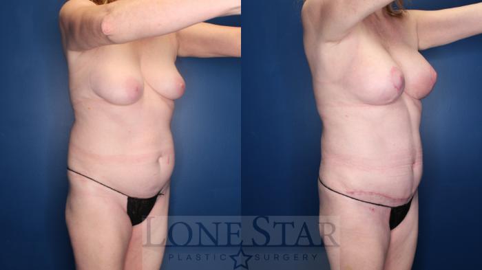 Before & After Breast Lift Case 152 Right Oblique View in Frisco, TX