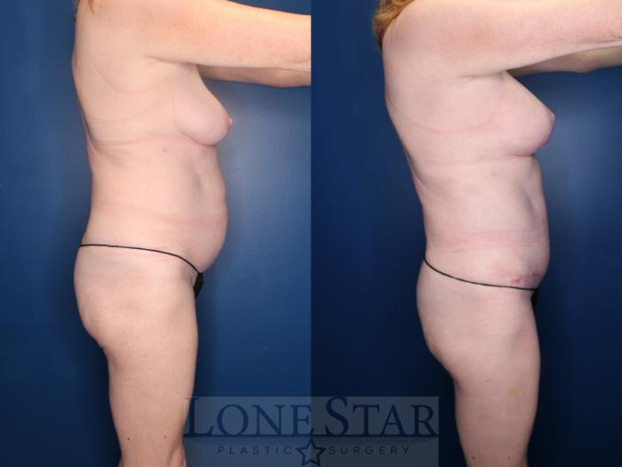 Before & After Breast Lift Case 152 Right Side View in Frisco, TX
