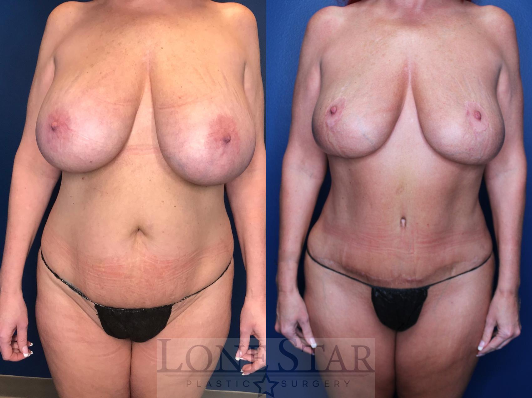 Before & After Tummy Tuck Case 153 Front View in Frisco, TX