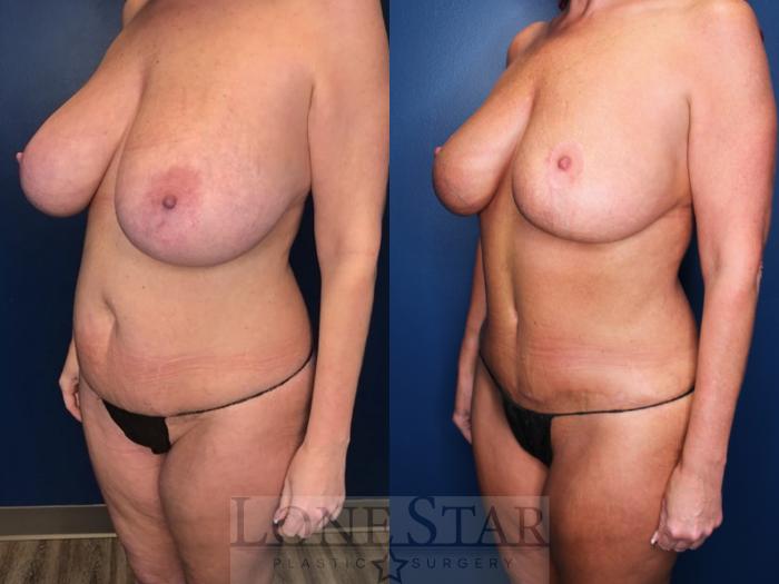 Before & After Mommy Makeover Case 153 Left Oblique View in Frisco, TX