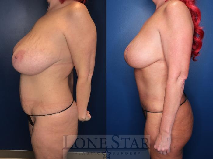 Before & After Breast Lift Case 153 Left Side View in Frisco, TX