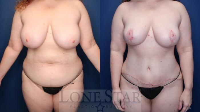 Before & After Tummy Tuck Case 171 Front View in Frisco, TX