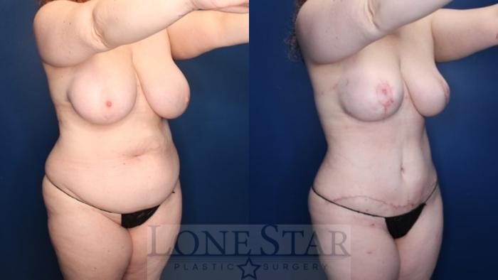 Before & After Mommy Makeover Case 171 Right Oblique View in Frisco, TX