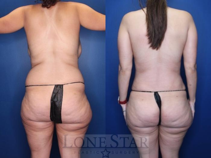 Before & After Mommy Makeover Case 184 Back View in Frisco, TX