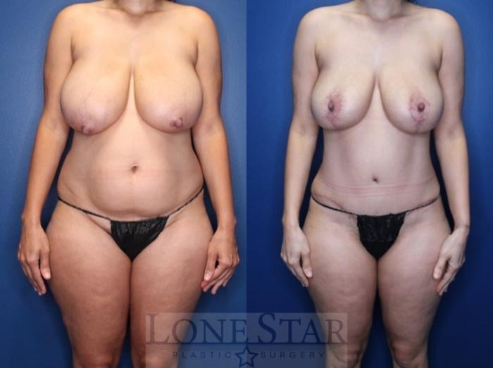 Before & After Tummy Tuck Case 184 Front View in Frisco, TX