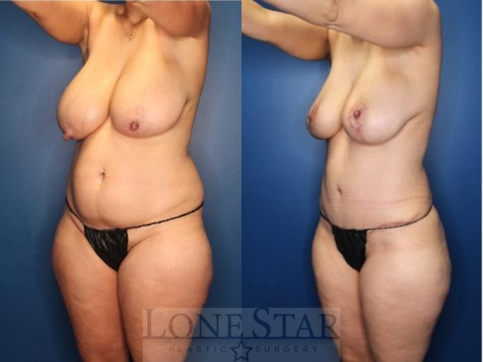 Before & After Mommy Makeover Case 184 Left Oblique View in Frisco, TX