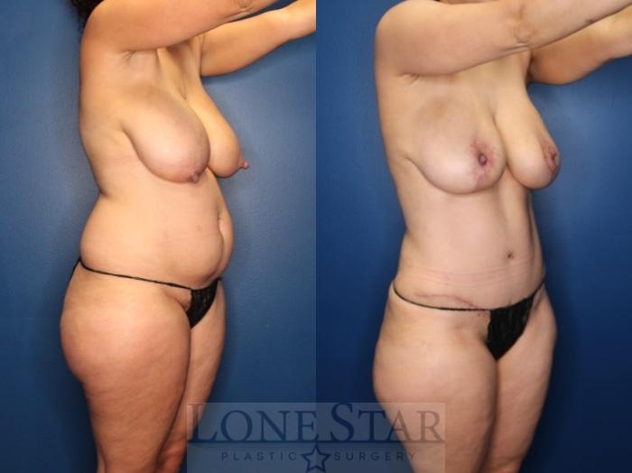 Before & After Mommy Makeover Case 184 Right Oblique View in Frisco, TX