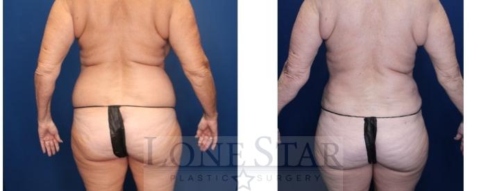 Before & After Liposuction Case 194 Back View in Frisco, TX