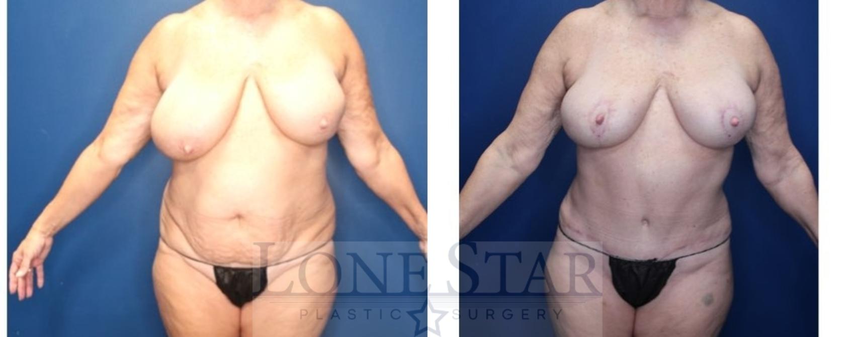 Before & After Liposuction Case 194 Front View in Frisco, TX