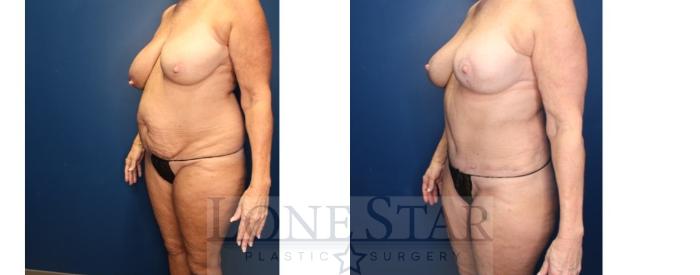 Before & After Mommy Makeover Case 194 Left Oblique View in Frisco, TX