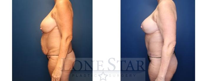 Before & After Liposuction Case 194 Left Side View in Frisco, TX