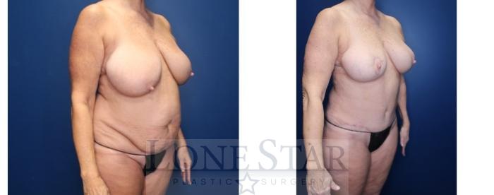 Before & After Liposuction Case 194 Right Oblique View in Frisco, TX