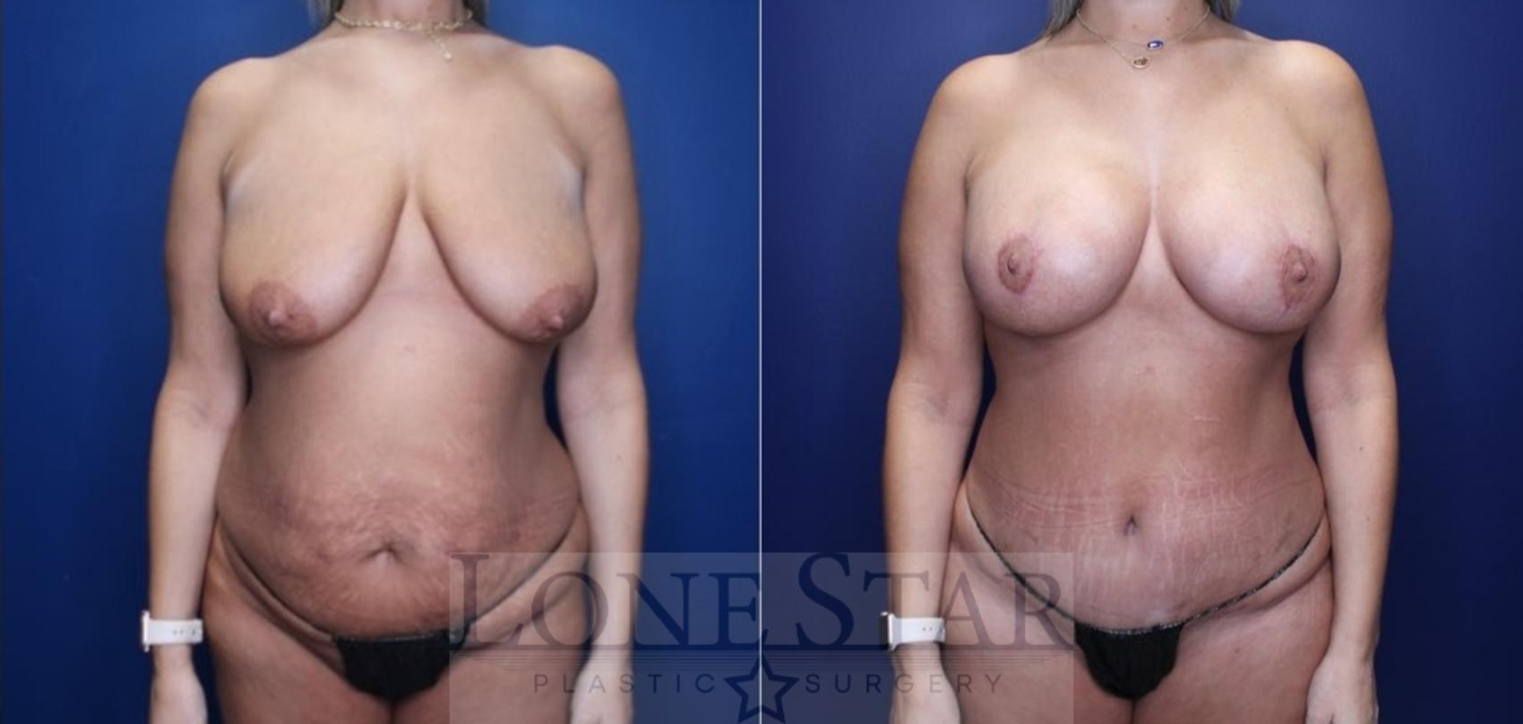 Before & After Mommy Makeover Case 220 Front View in Frisco, TX