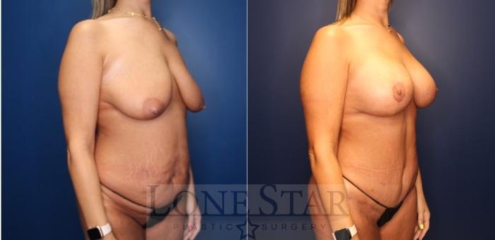 Before & After Mommy Makeover Case 220 Right Oblique View in Frisco, TX