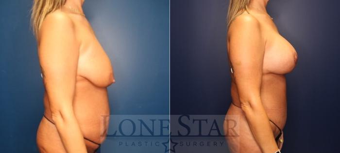 Before & After Mommy Makeover Case 220 Right Side View in Frisco, TX