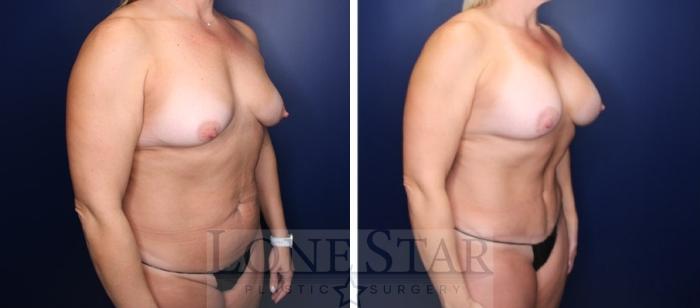 Before & After Mommy Makeover Case 224 Left Oblique View in Frisco, TX
