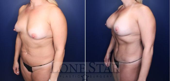 Before & After Mommy Makeover Case 224 Right Oblique View in Frisco, TX