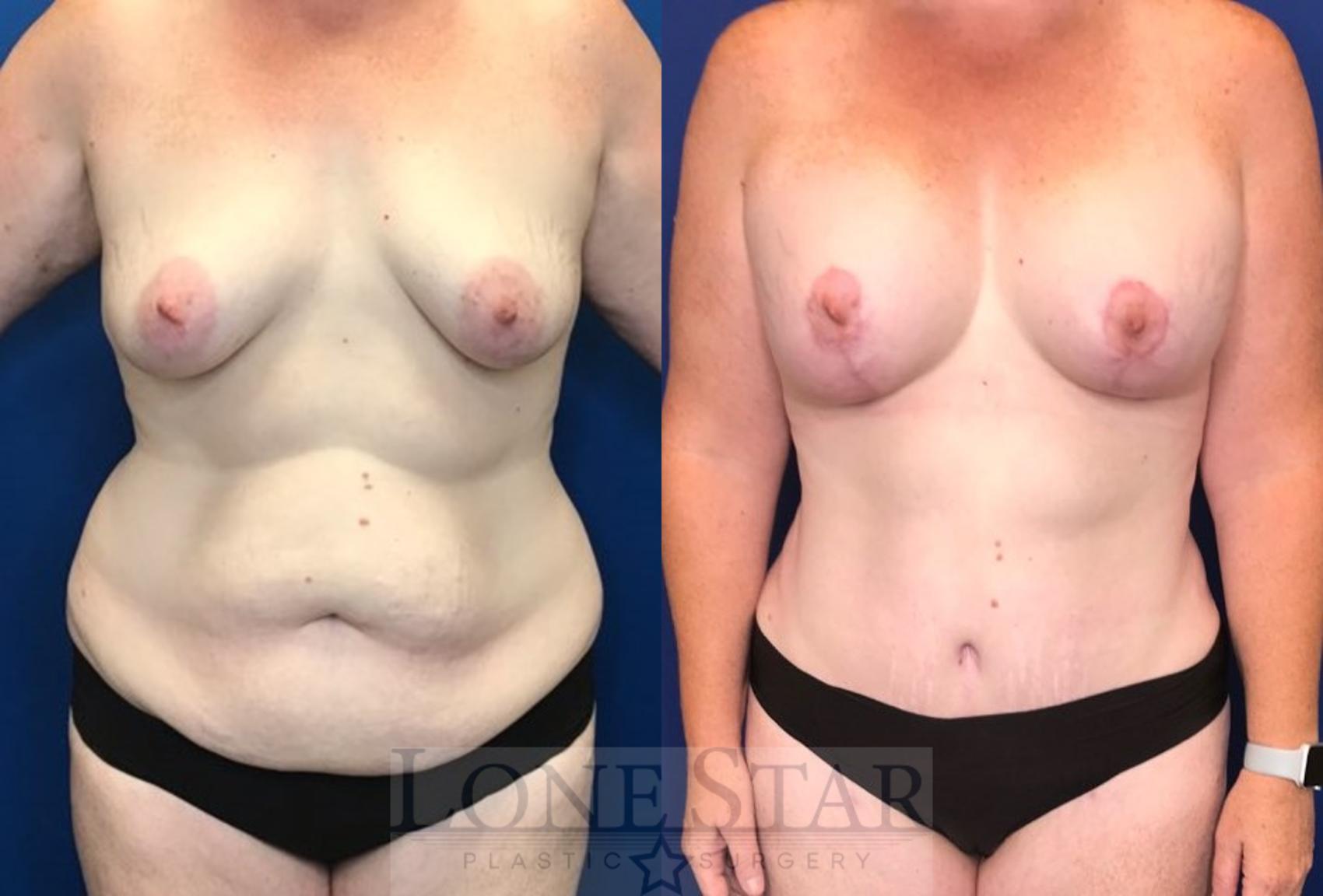 Before & After Breast Augmentation Case 45 View #1 View in Frisco, TX