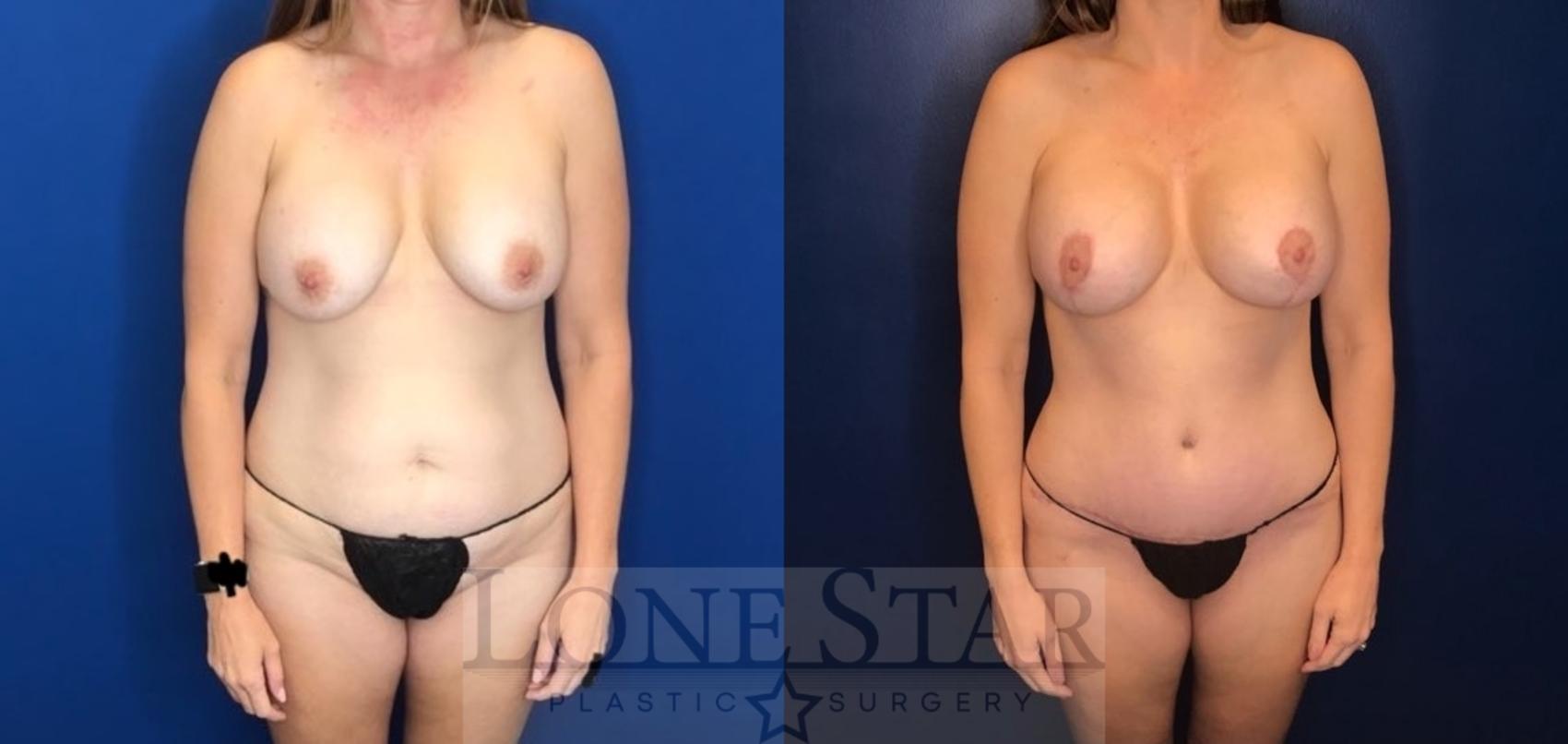 Before & After Breast Augmentation with Lift Case 62 Front View in Frisco, TX