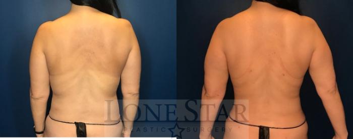 Before & After Breast Lift Case 74 Back View in Frisco, TX