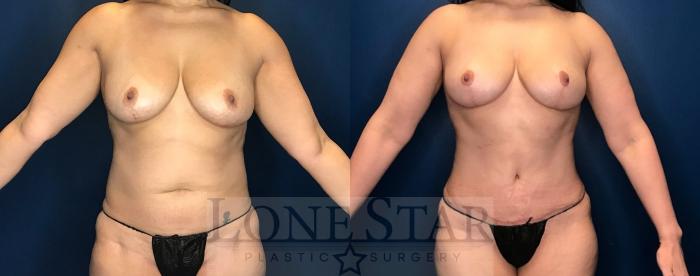 Before & After Tummy Tuck Case 74 Front View in Frisco, TX
