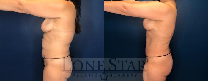 Before & After Breast Lift Case 74 Left Side View in Frisco, TX