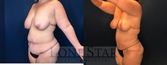 Before & After Mommy Makeover Case 82 Left Oblique View in Frisco, TX