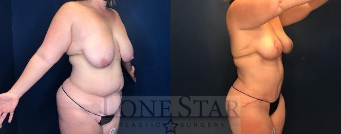Before & After Mommy Makeover Case 82 Right Oblique View in Frisco, TX