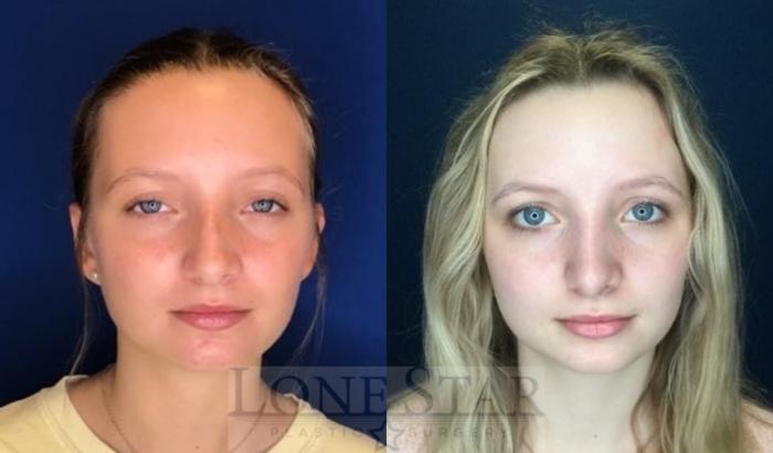 Before & After Rhinoplasty Case 110 Front View in Frisco, TX