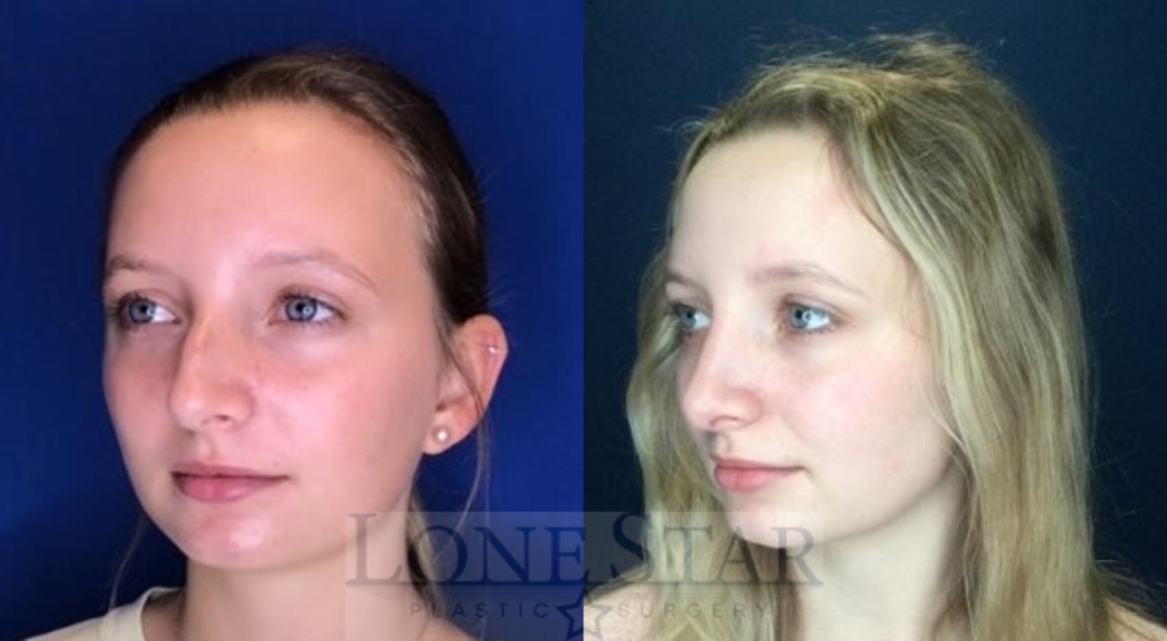Before & After Rhinoplasty Case 110 Left Oblique View in Frisco, TX