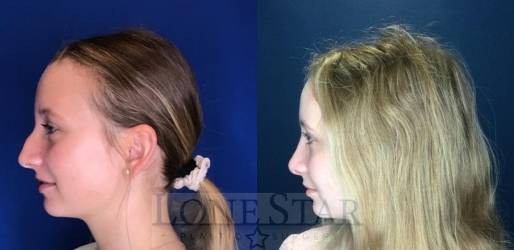 Before & After Rhinoplasty Case 110 Left Side View in Frisco, TX
