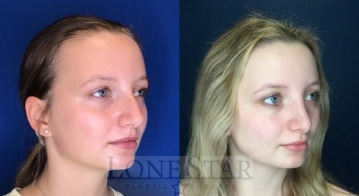 Before & After Rhinoplasty Case 110 Right Oblique View in Frisco, TX