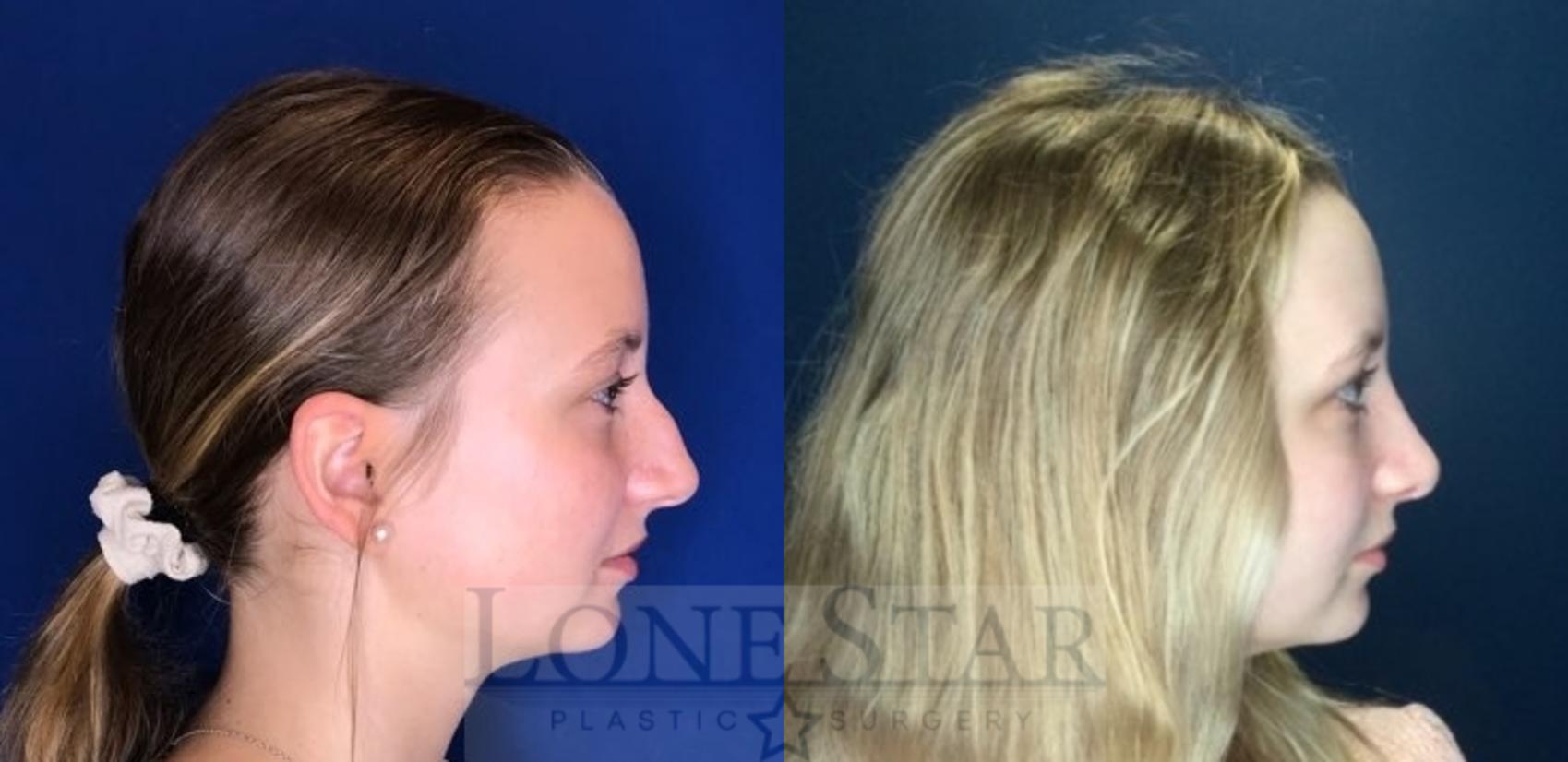 Before & After Rhinoplasty Case 110 Right Side View in Frisco, TX