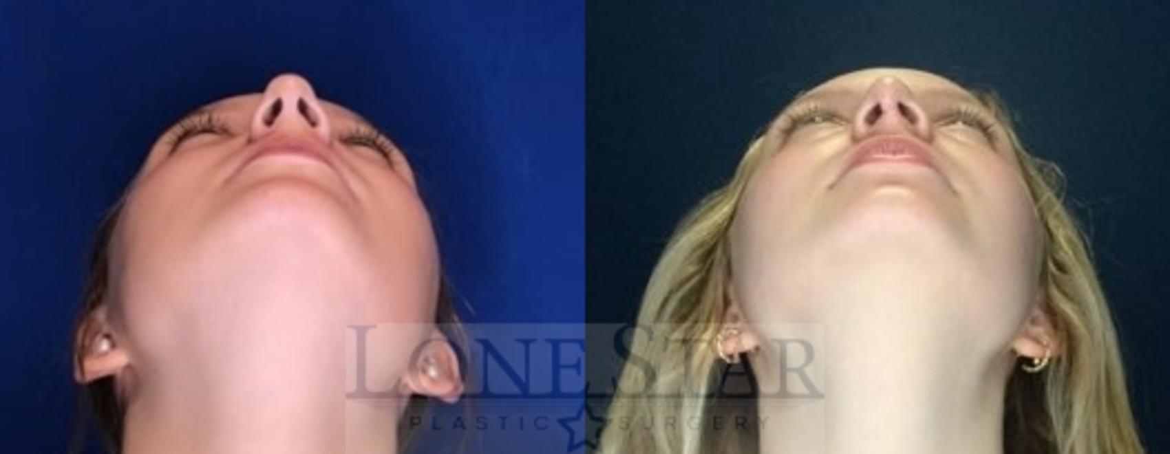 Before & After Rhinoplasty Case 110 Worm's-eye View in Frisco, TX