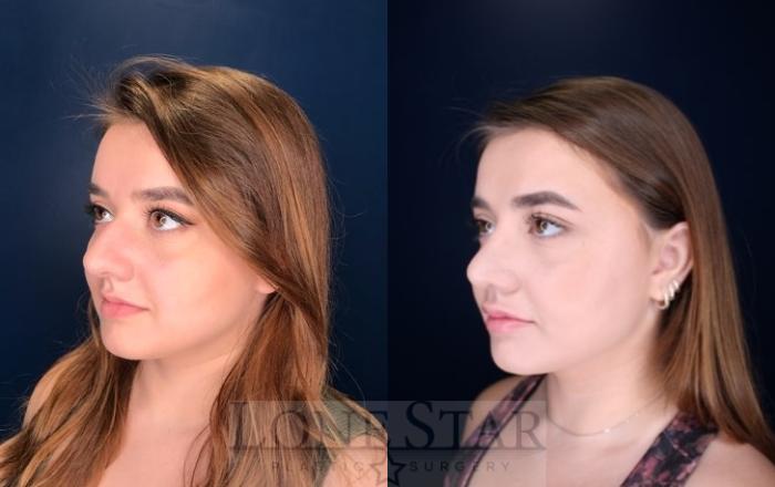 Before & After Rhinoplasty Case 114 Left Oblique View in Frisco, TX