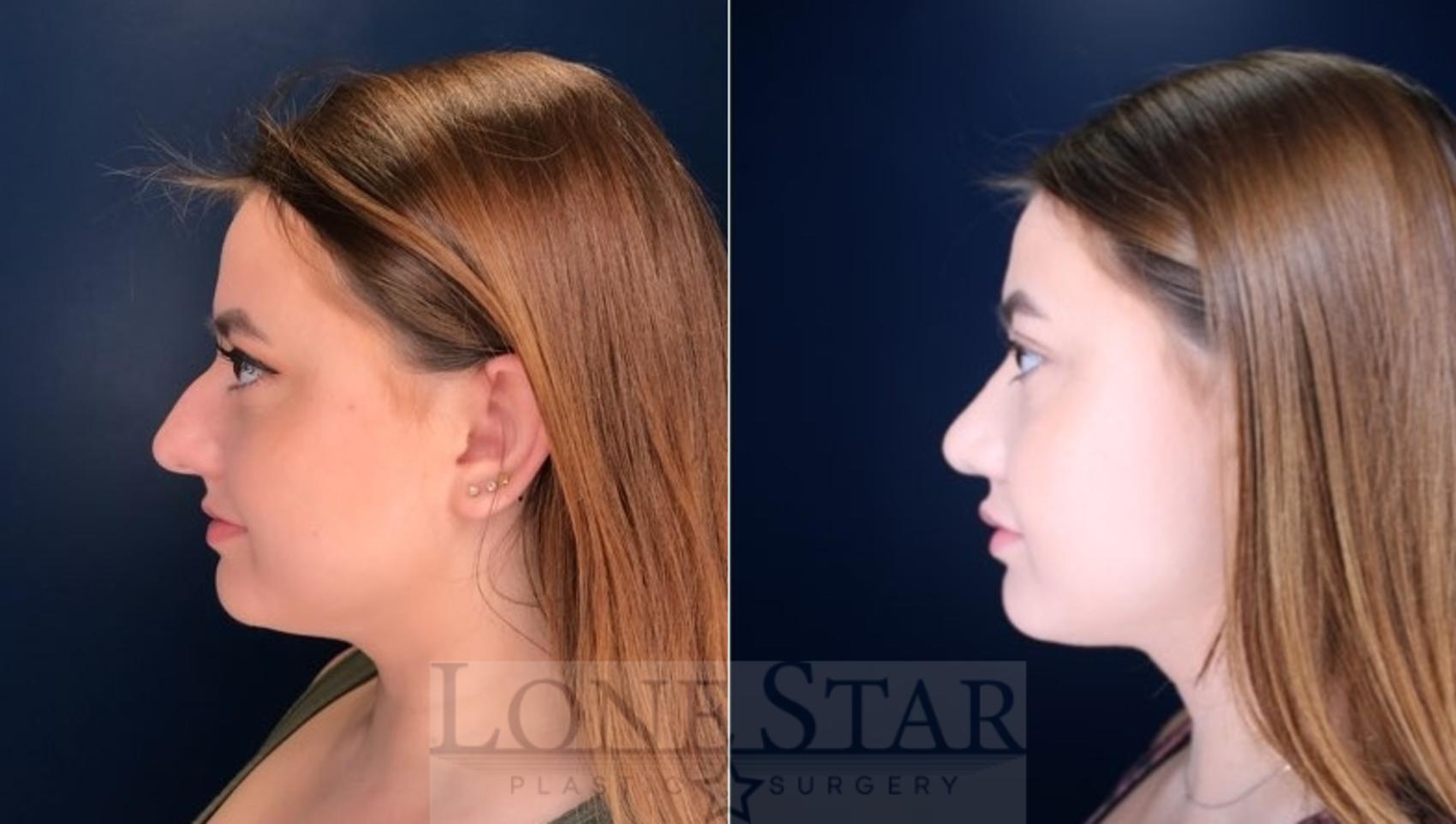Before & After Rhinoplasty Case 114 Left Side View in Frisco, TX