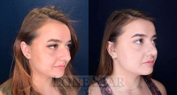Before & After Rhinoplasty Case 114 Right Oblique View in Frisco, TX